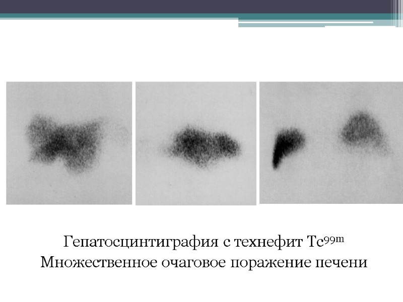 Гепатосцинтиграфия с технефит Tc99m Множественное очаговое поражение печени
